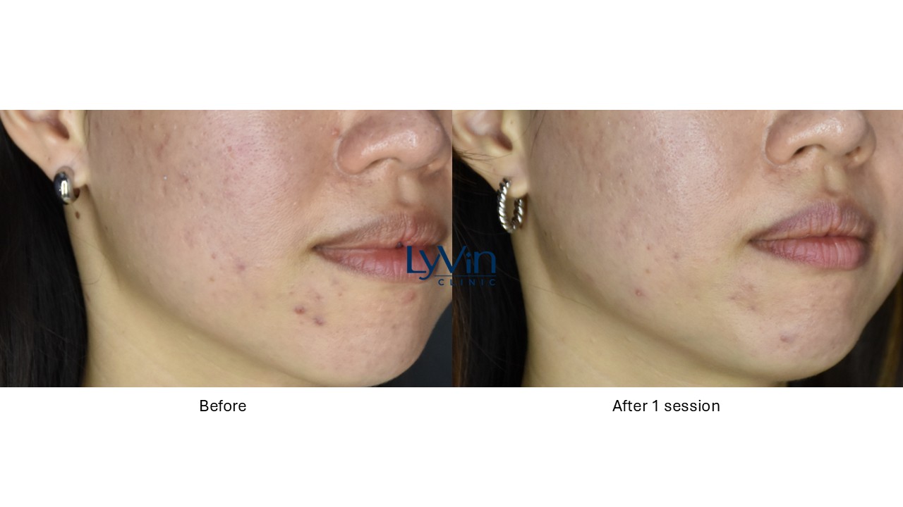 Profhilo before and after photo showing skin hydration and glow improvement